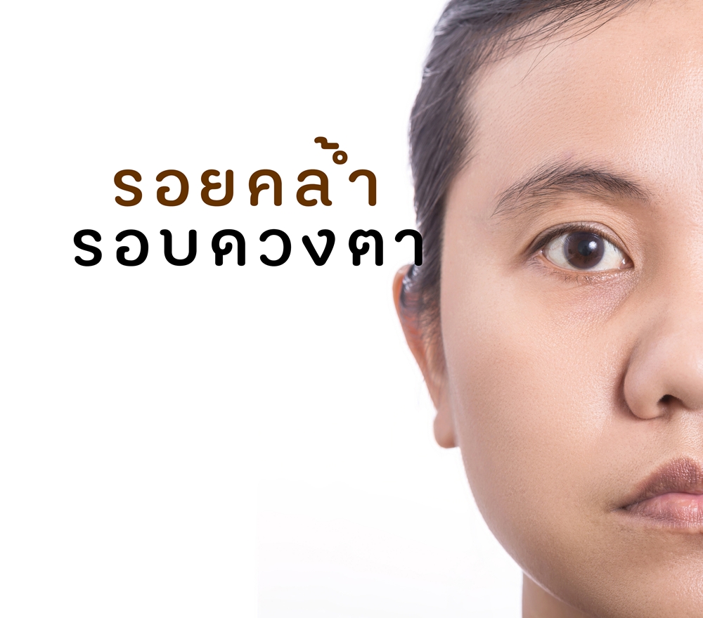 รอยคล้ำ รอบดวงตา thaihealth