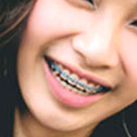 อันตราย! วัยรุ่นแห่จัดฟันแฟชั่น